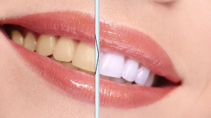 Whitening Pen - Verlicht Je Glimlach